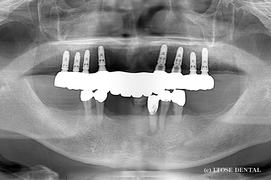 上顎8本のインプラントで12本のセラミック製インプラント上部構造を